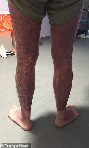 Doctors informed him that he should have died in the blaze and that he was a miracle