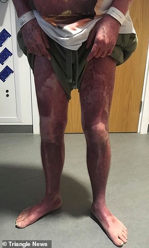 Reece doesn't remember the fire but he does remember vivid dreams of being in the hospital while he was recovering