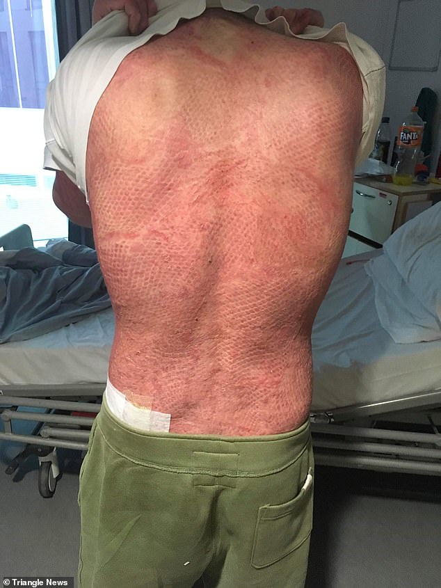 Reece thought no one would love him after being burned until he found his current girlfriend. Reece's 3rd degree burns after being in the hospital