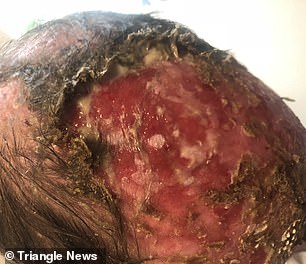 Reece with fresh wounds. The long-term effects of his burns are pain walking, thick scars that turn purple in the winter due to lack of circulation and poor eyesight