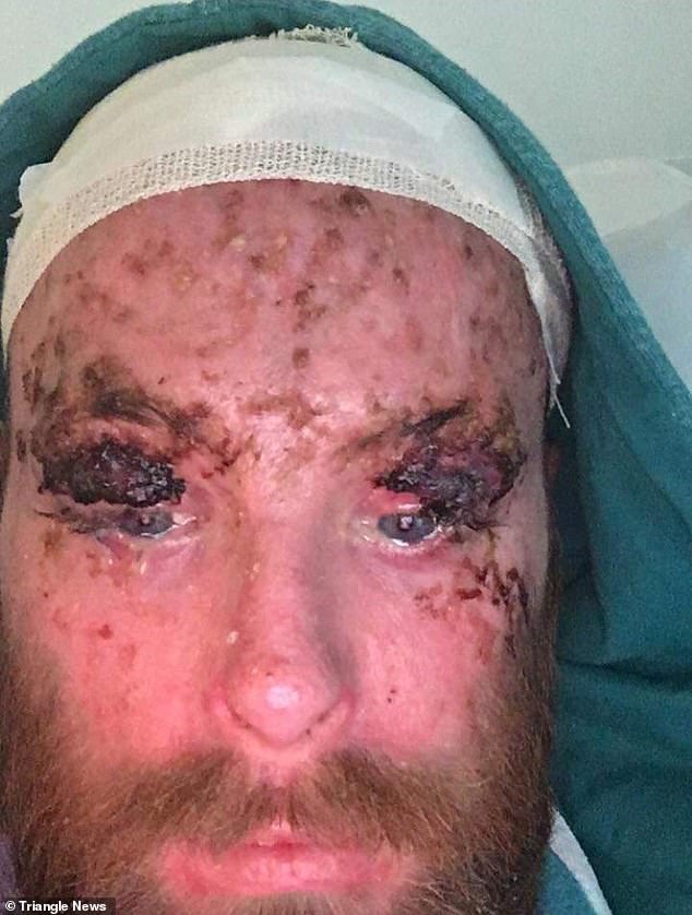 Reece's 3rd degree burns, including his eyelids which were so damaged in the blaze that he couldn't close his eyes.