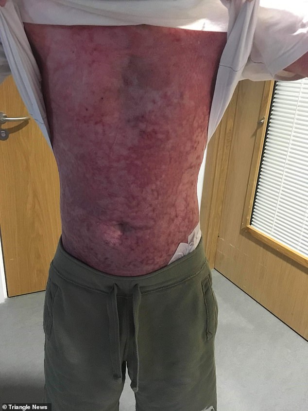 Reece suffered third degree burns and admitted that adjusting to his new face was hard to come to terms with