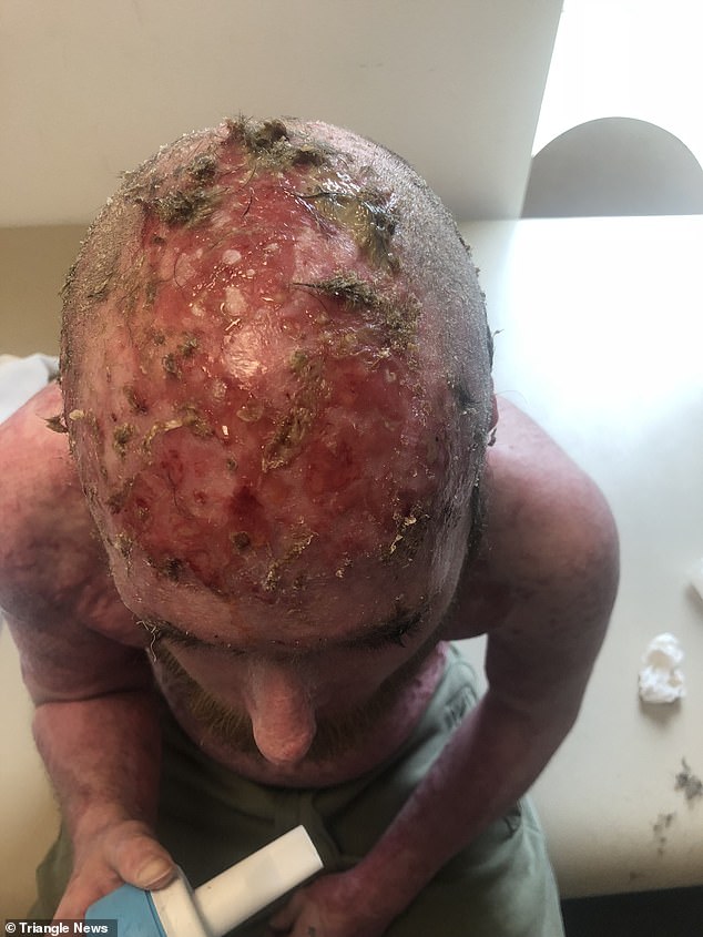 Reece is now bald as a result of his third degree burns and has accepted it, but will be ge6tting surgery to reconstruct his eyebrows