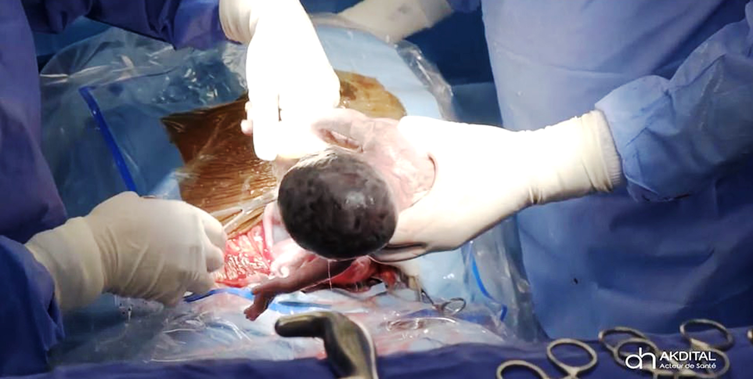 The nine babies were delivered via C-section